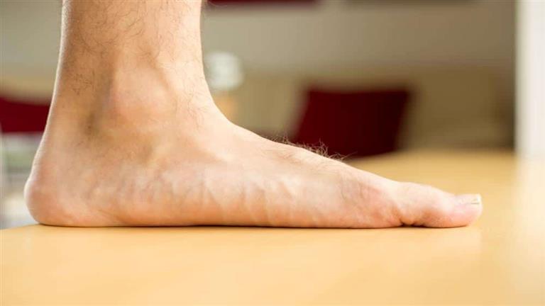 ما أسباب وأعراض الأقدام المسطحة؟