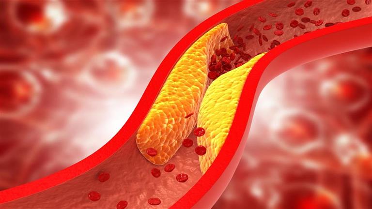 3 علامات خطيرة تشير إلى ارتفاع الكوليسترول في الدم