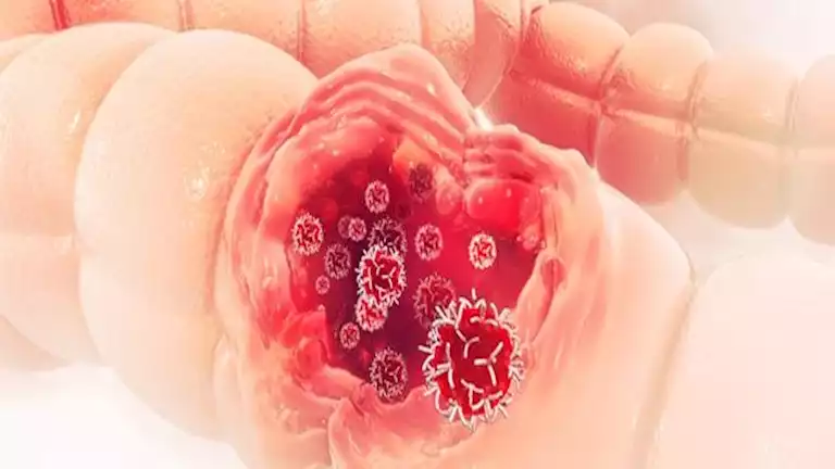 ارتفاع مخيف في إصابات سرطان الأمعاء بين الشباب